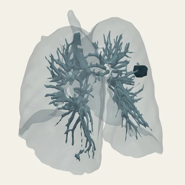 Both lungs from a chest CT in three dimensions, the blood vessels branching inside them, and one dark, round nodule.
